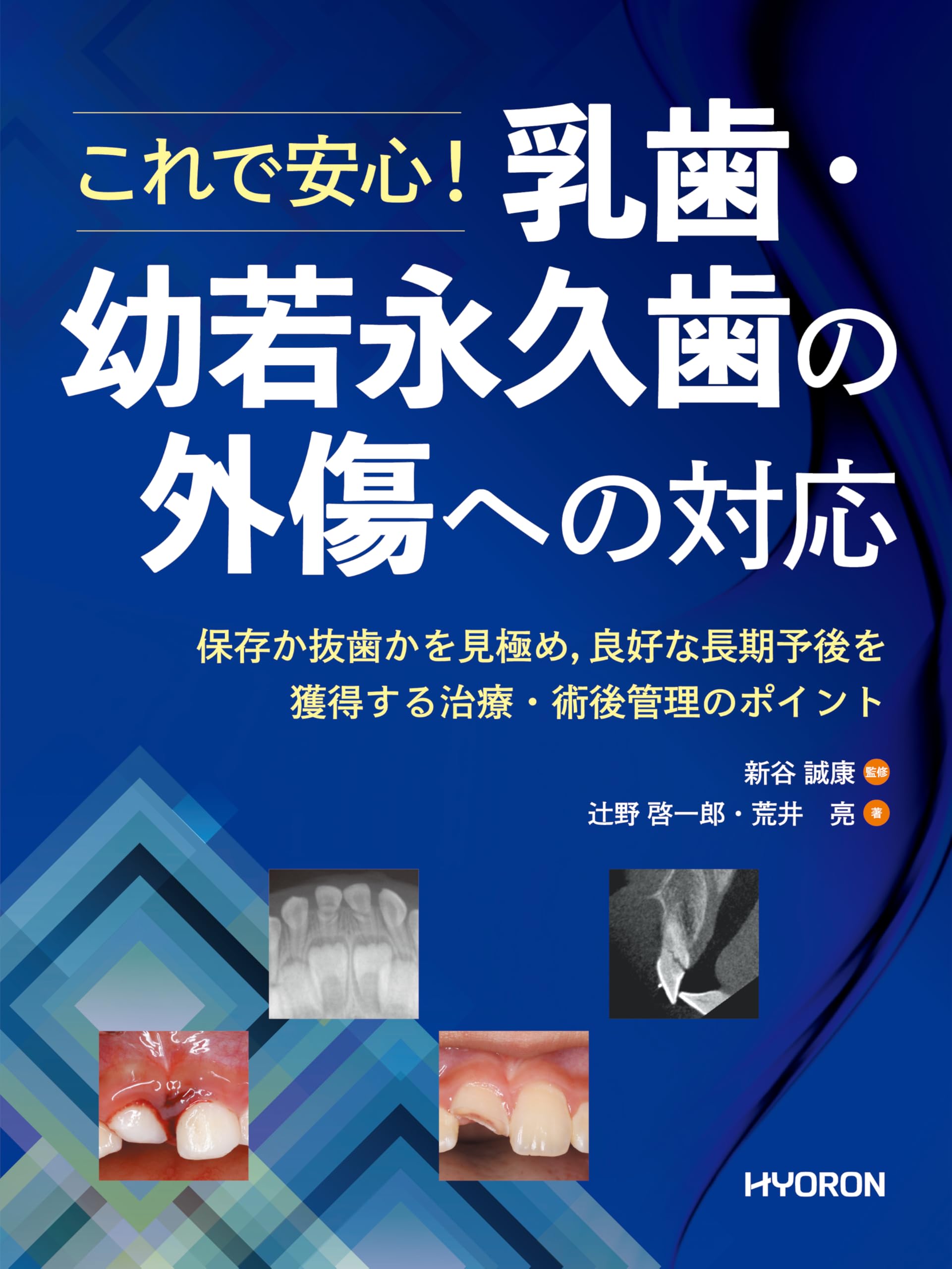 ⚠裁断済　乳歯・幼若永久歯の外傷への対応　☆ ⚠裁断済 乳歯・幼若永久歯の外傷への対応 ☆